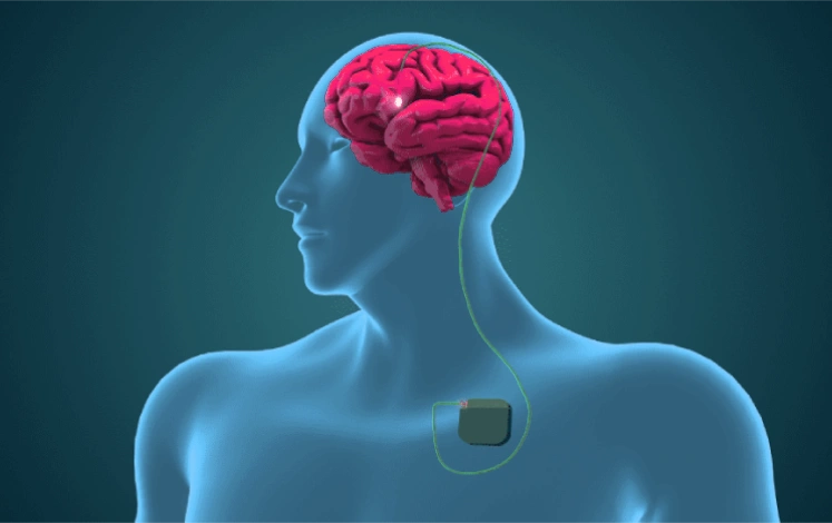 Deep Brain Stimulation Surgery in Mumbai